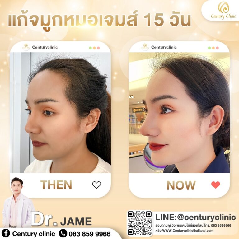 Century-รีวิว-แก้จมูก #699