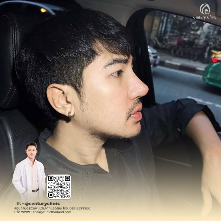 Century-รีวิว-แก้จมูก #713