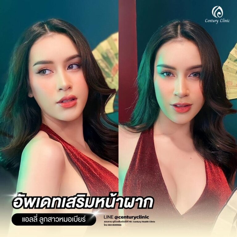 Review เสริมหน้าผาก #27