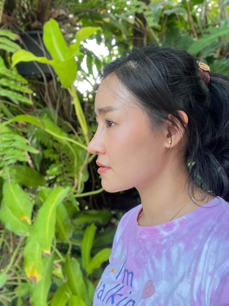 รีวิว แก้จมูก #737 , Century Clinic Thailand Century-รีวิว-แก้จมูก 2#737