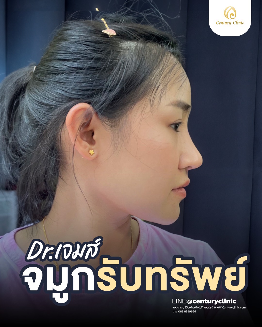 รีวิว แก้จมูก #737 , Century Clinic Thailand Century-รีวิว-แก้จมูก #737