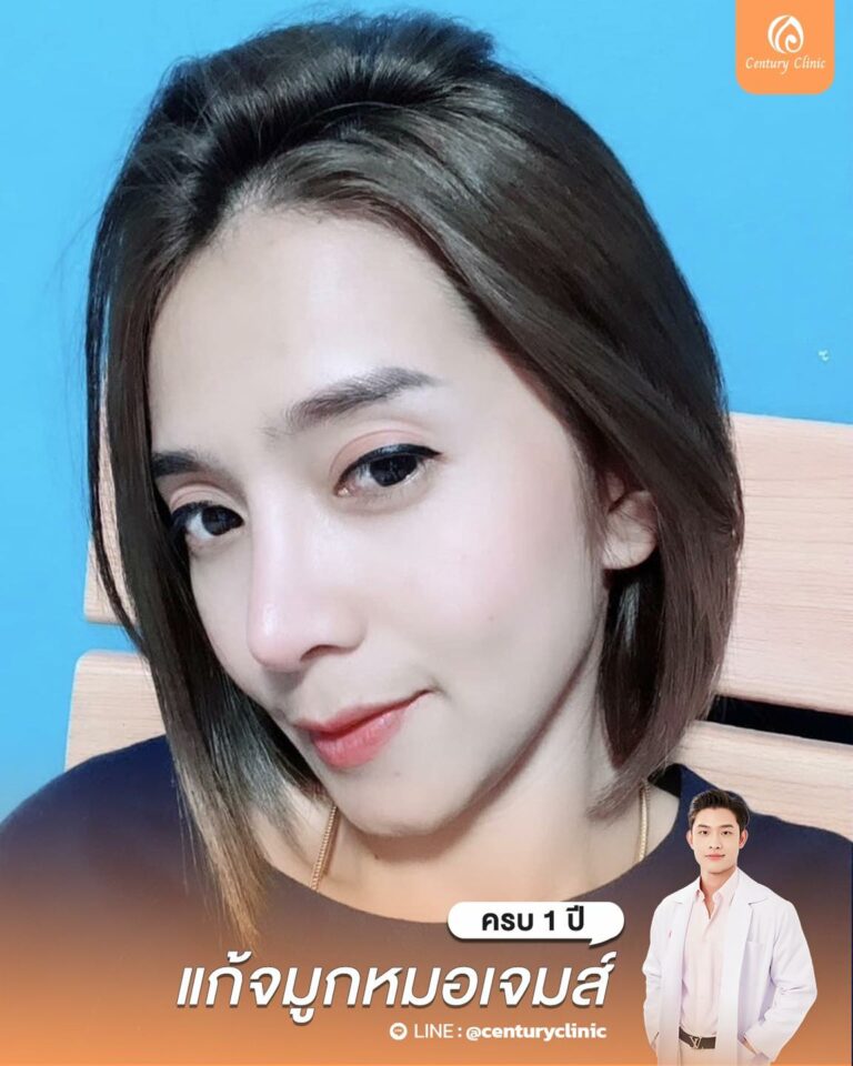 Century-รีวิว-แก้จมูก #758