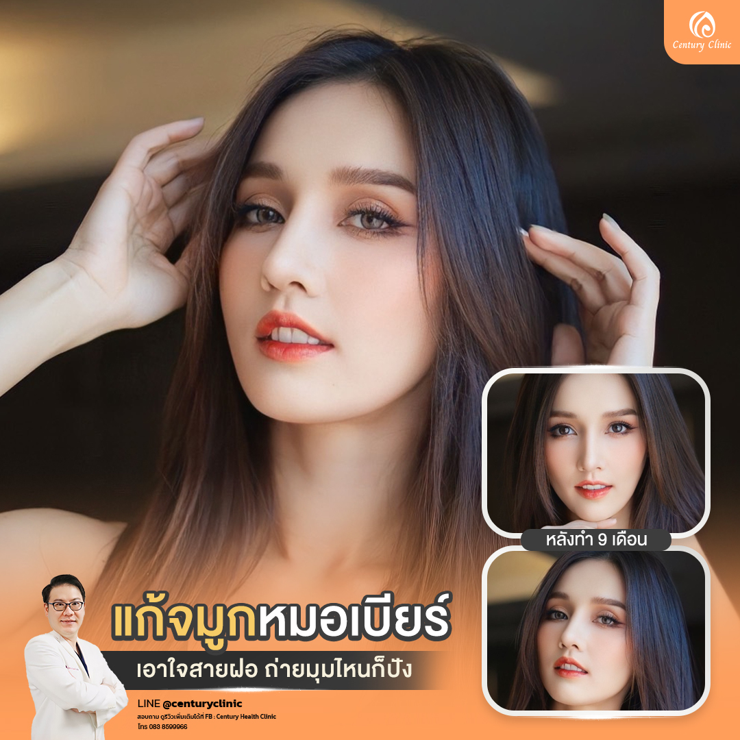 Century-รีวิว-แก้จมูก #761