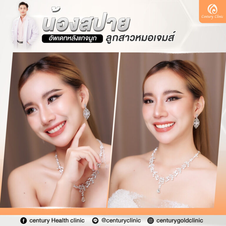 Century-รีวิว-แก้จมูก #766
