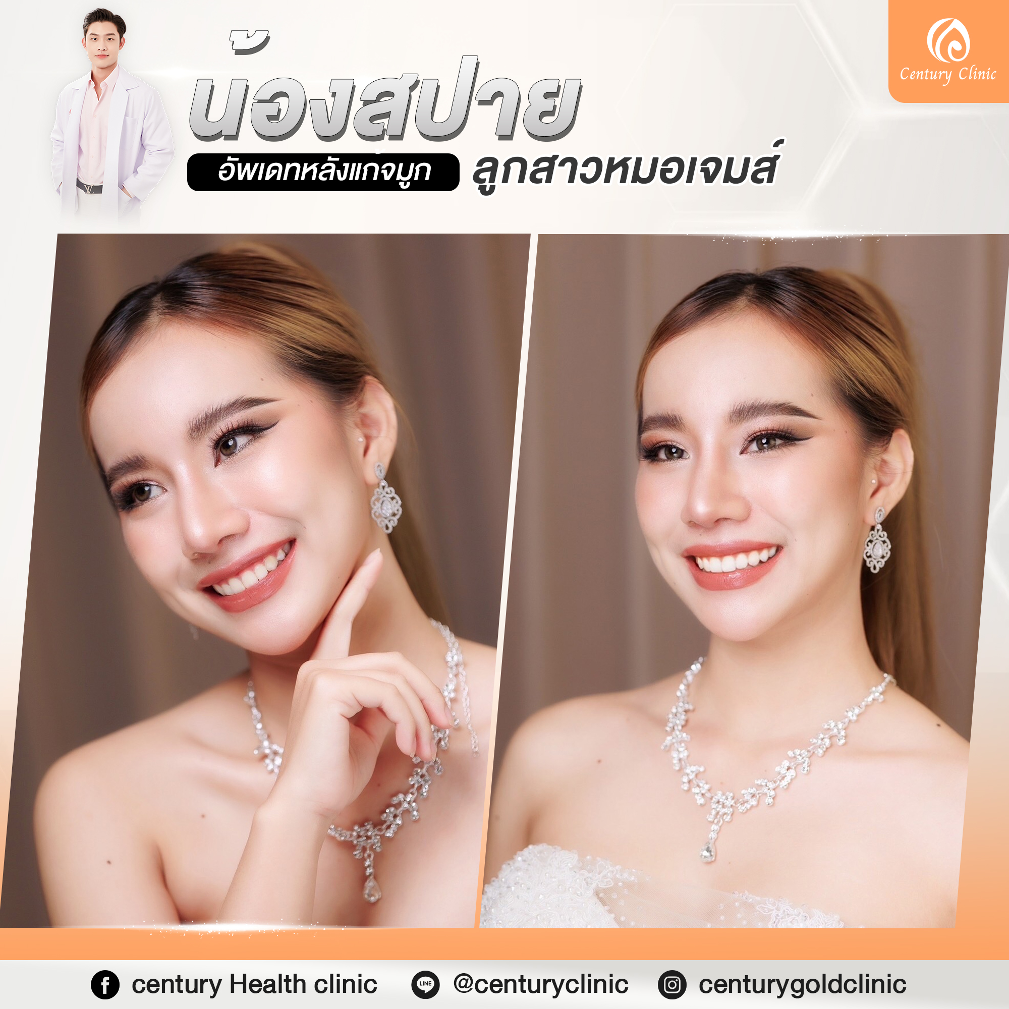 รีวิว แก้จมูก #766 , Century Clinic Thailand Century-รีวิว-แก้จมูก #766