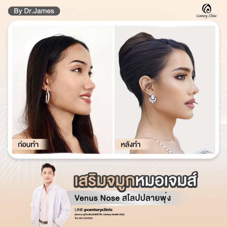 Century-รีวิว-เสริมจมูก #776