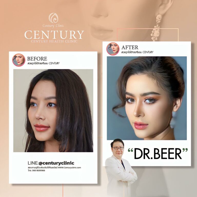 Century-เสริมจมูก #770
