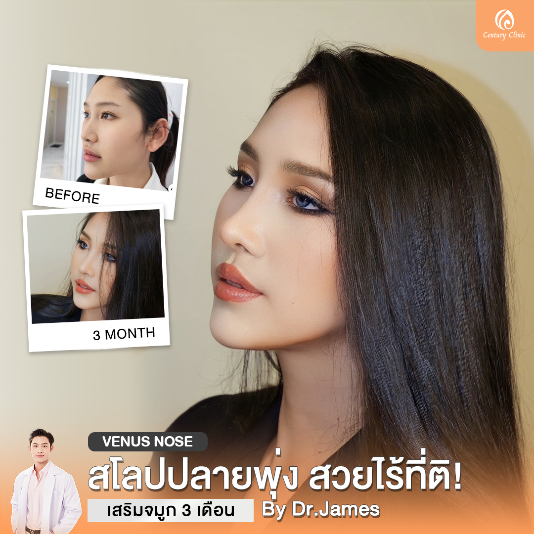 Century-รีวิว-เสริมจมูก #829