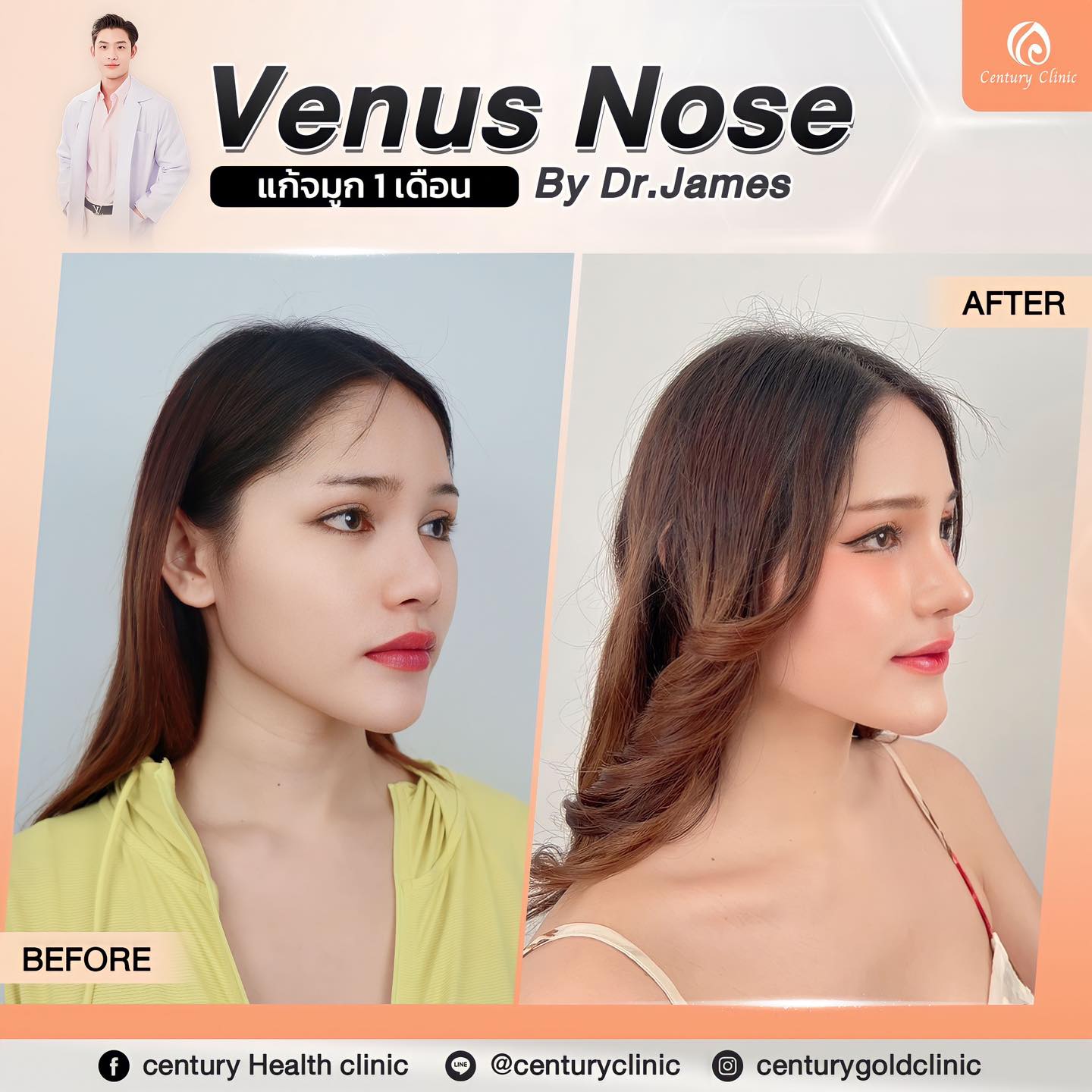รีวิว แก้จมูก #784 , Century Clinic Thailand Century-รีวิว-แก้จมูก #784