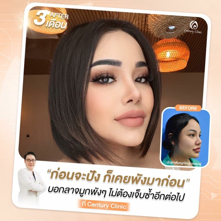 Century-รีวิว-แก้จมูก #799