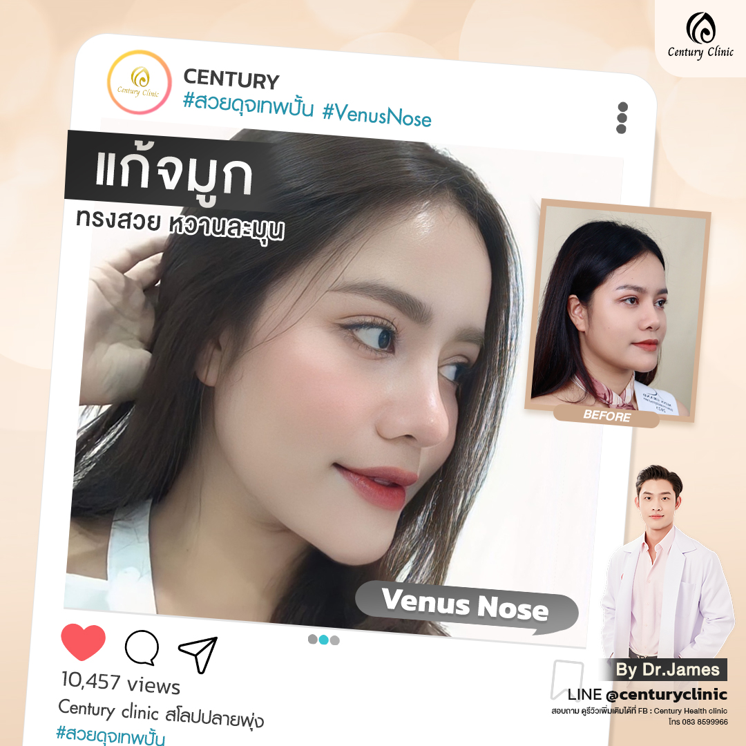 Century-รีวิว-แก้จมูก #808