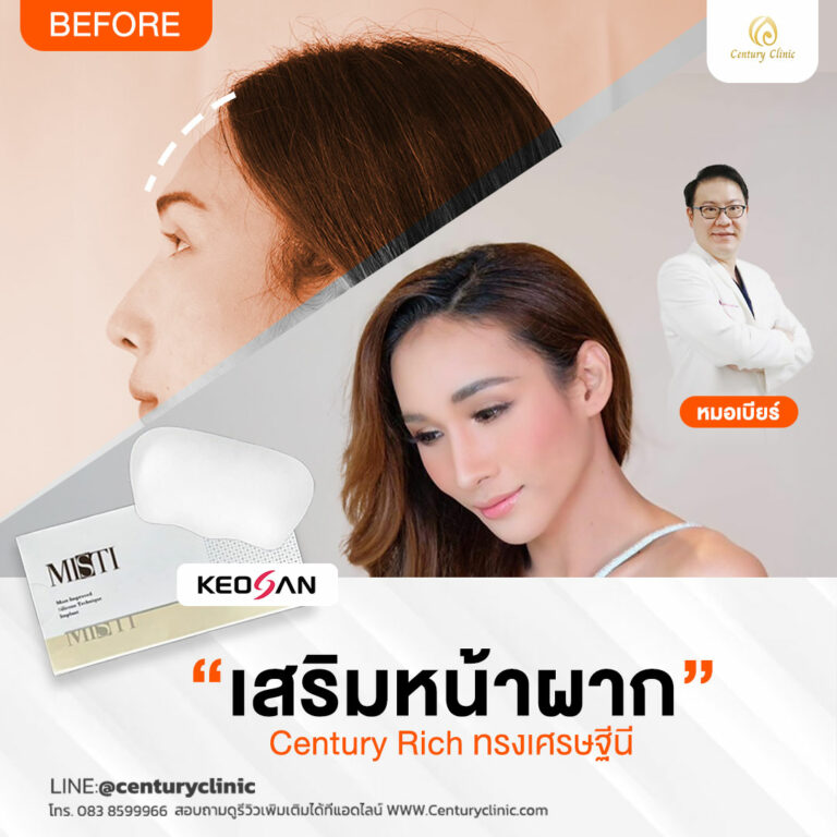 Review เสริมหน้าผาก #32