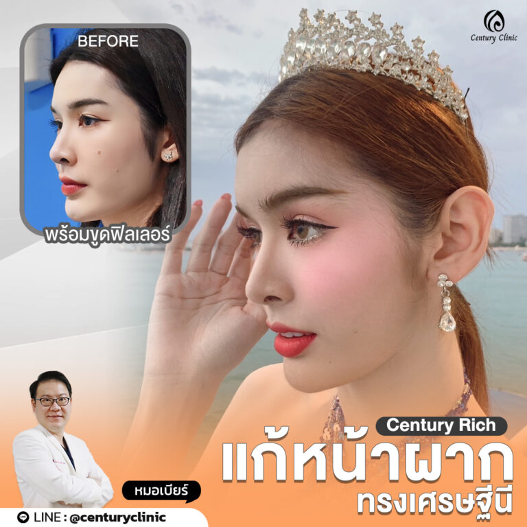 Review เสริมหน้าผาก #34