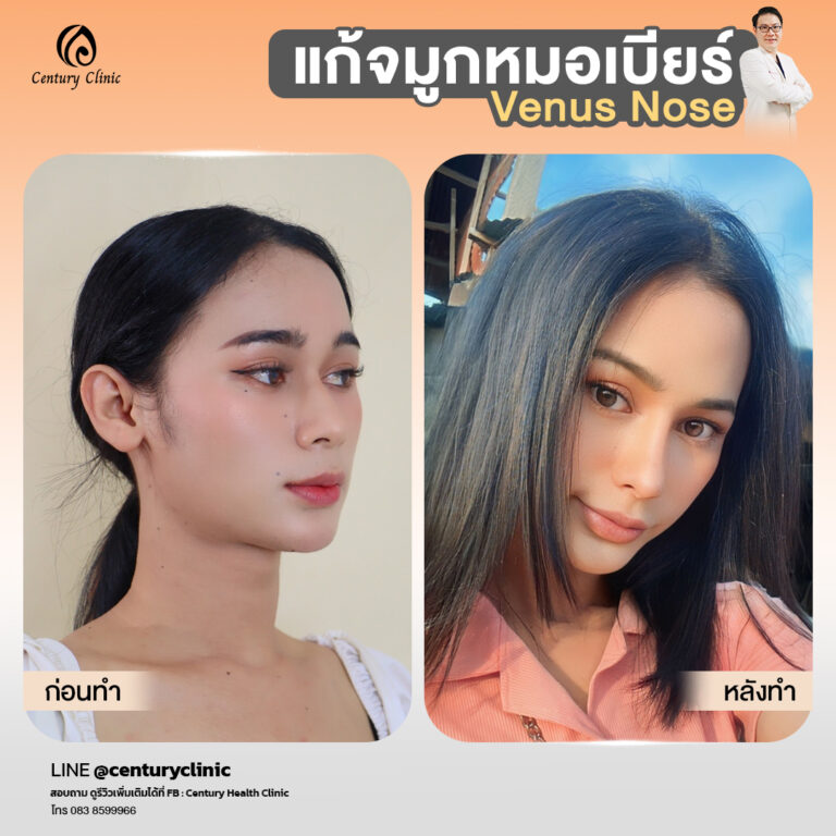 รีวิว แก้จมูก #837