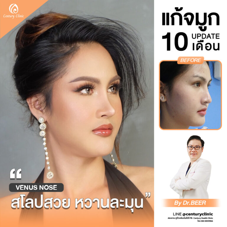 รีวิว แก้จมูก #840