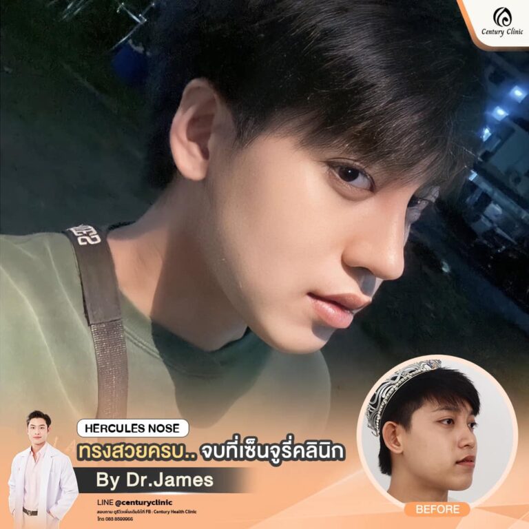 รีวิวเสริมจมูก #830