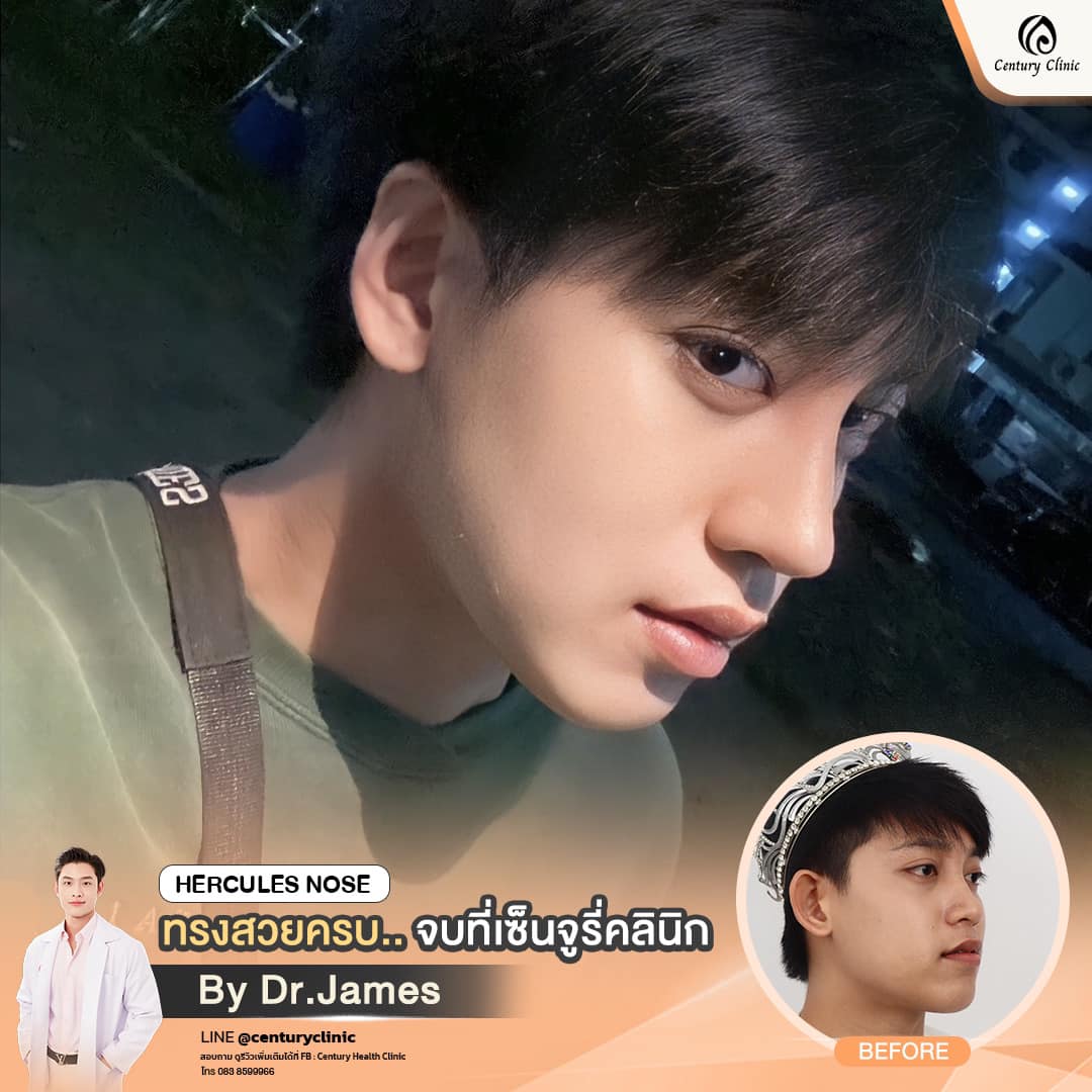 รีวิวเสริมจมูก #830