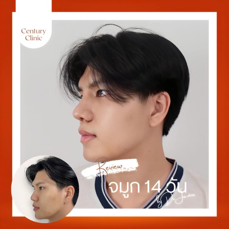 เสริมจมูก #897