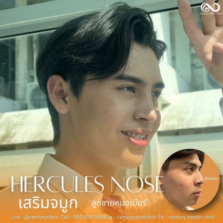 เสริมจมูก #918