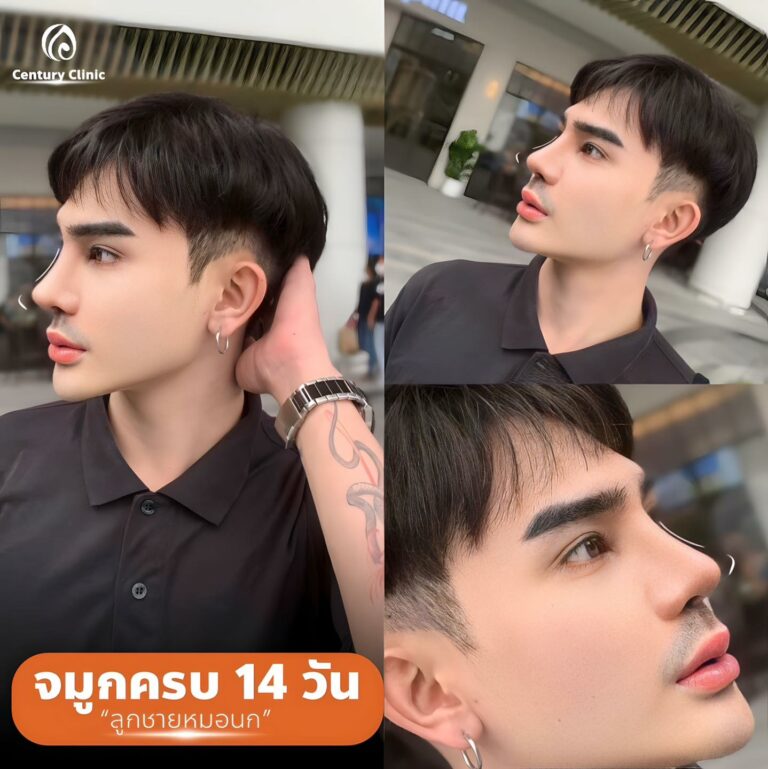 แก้จมูก #891