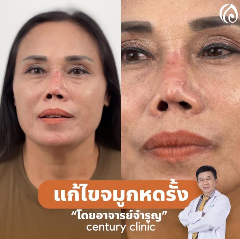 แก้จมูก #917
