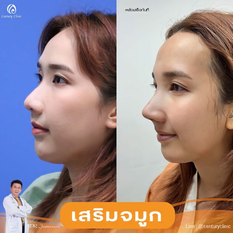 เสริมจมูก #969