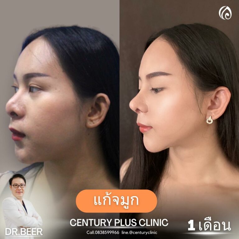แก้จมูก #932