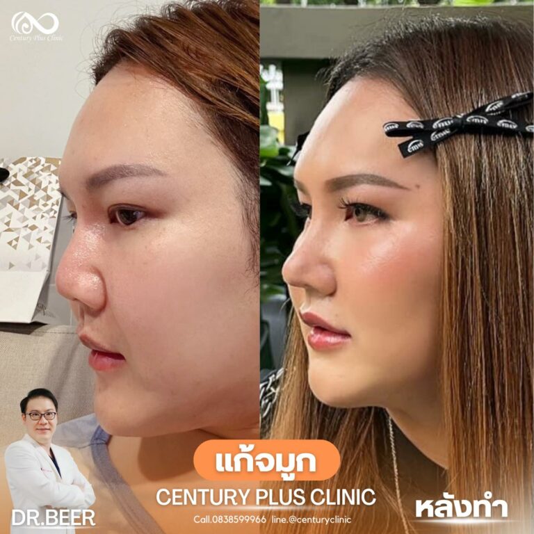 แก้จมูก #956