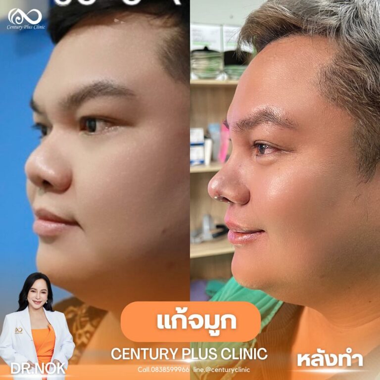 แก้จมูก #967