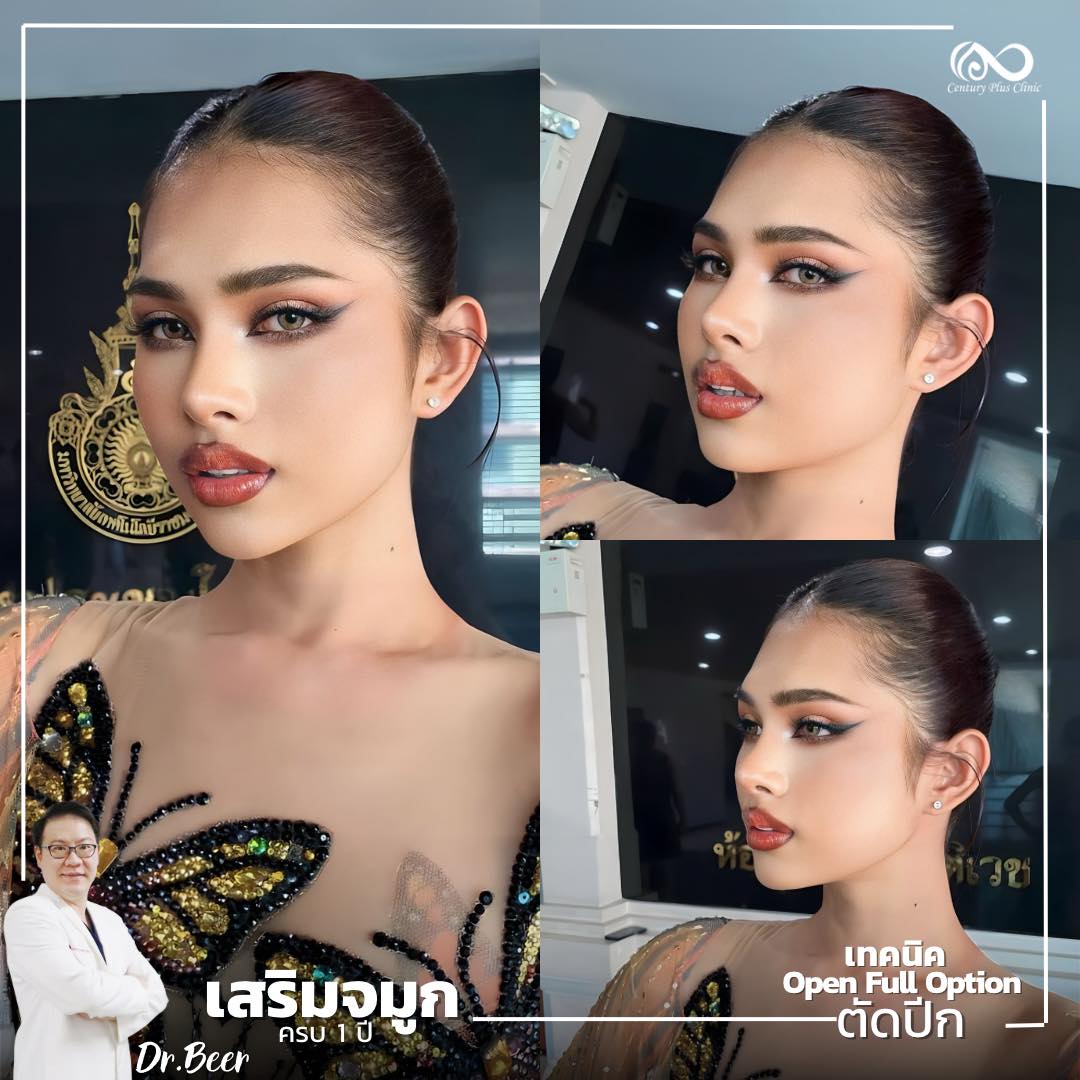 เสริมจมูก #1025