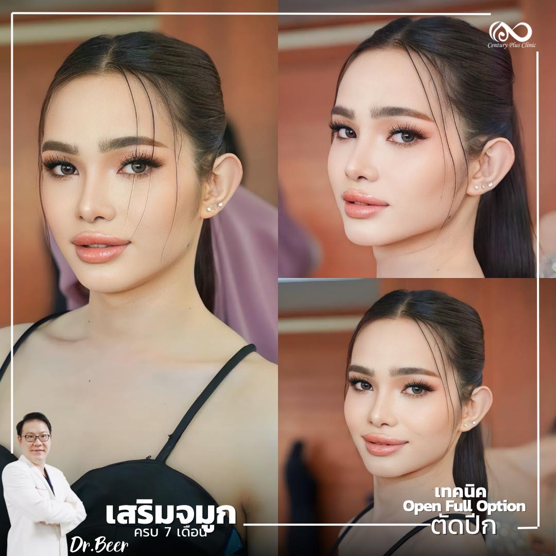 รีวิว เสริมจมูก #1029 , Century Clinic Thailand เสริมจมูก #1029