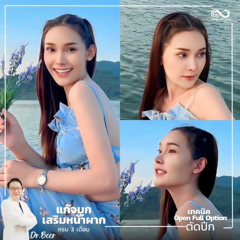 แก้จมูก #1032