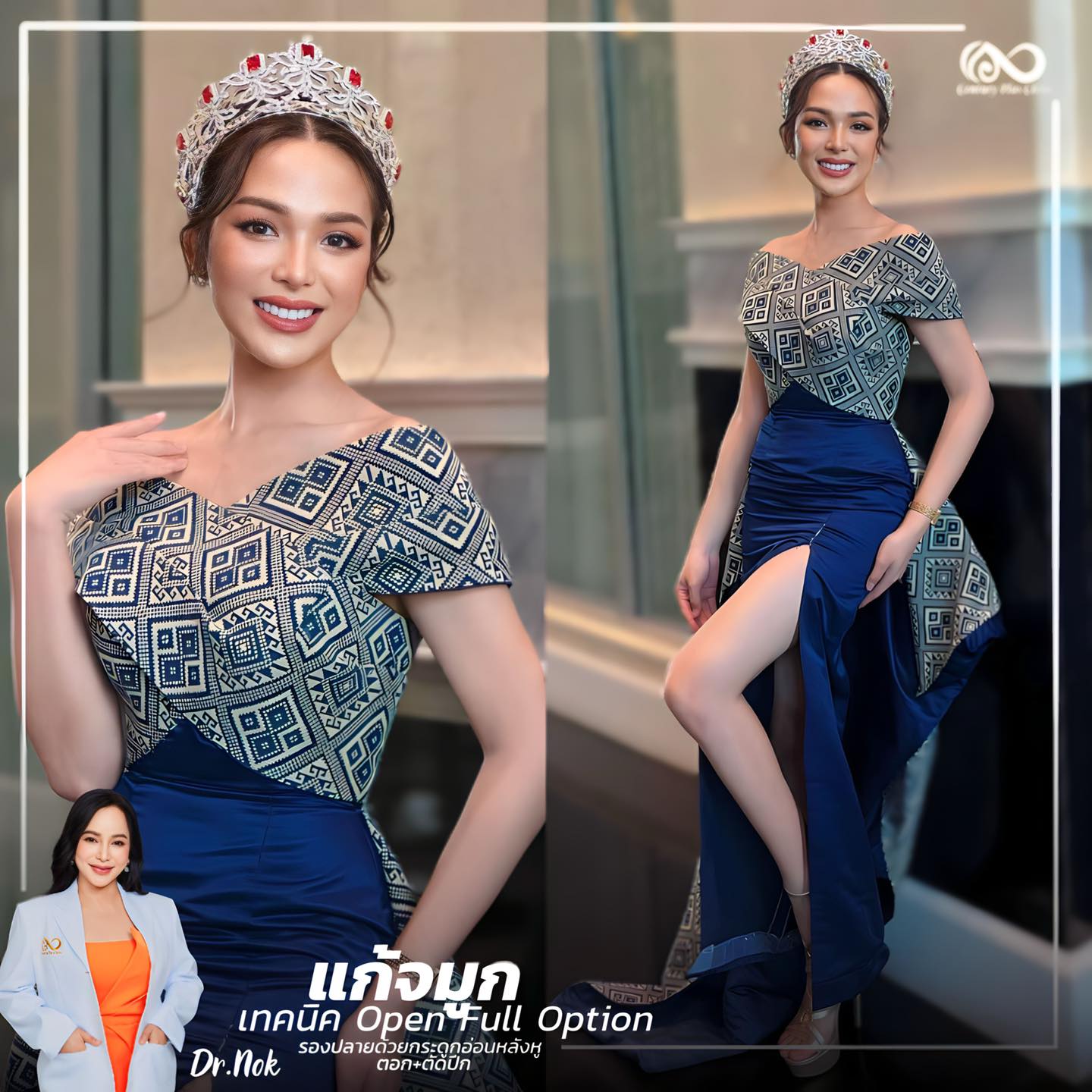 รีวิว แก้จมูก #1040 , Century Clinic Thailand แก้จมูก #1040