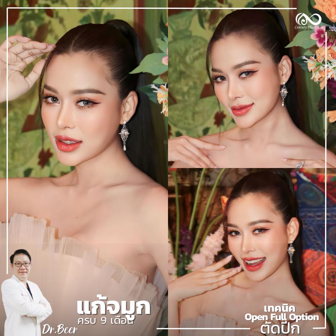 แก้จมูก #1068