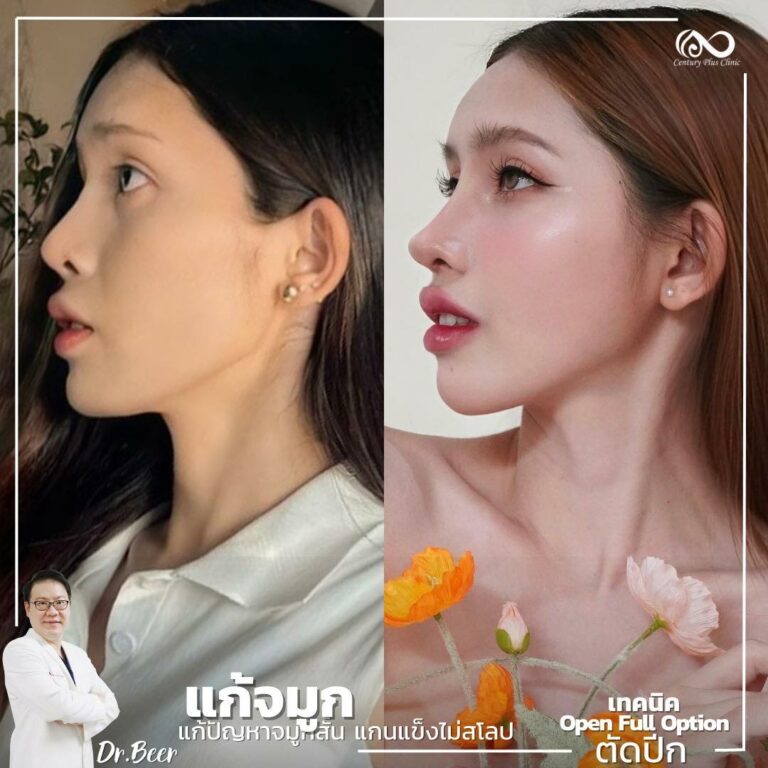 แก้จมูก #1072