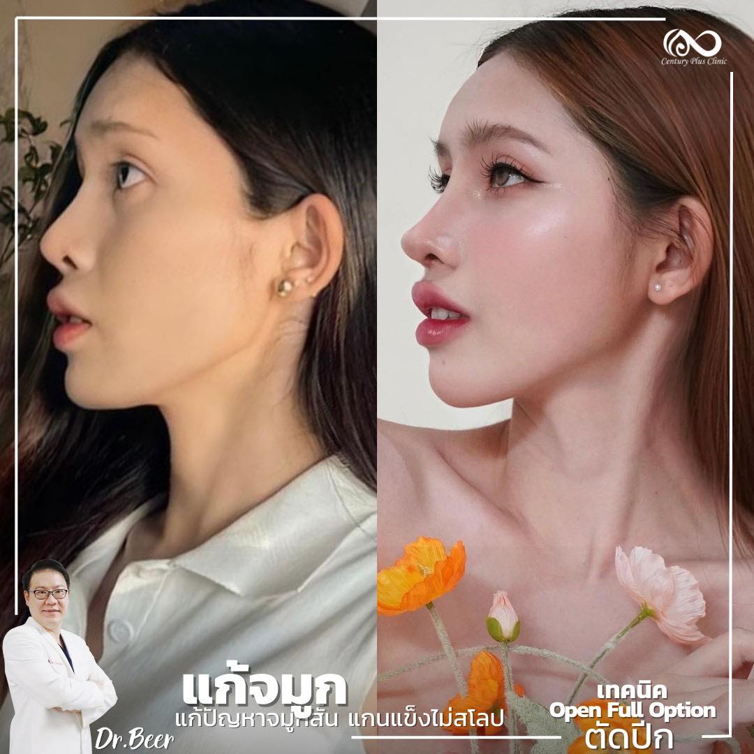 แก้จมูก #1072