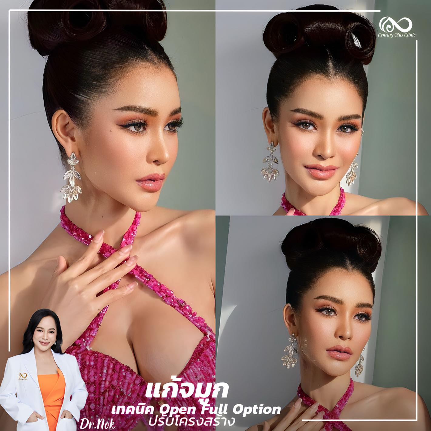รีวิว แก้จมูก #1074 , Century Clinic Thailand แก้จมูก #1074
