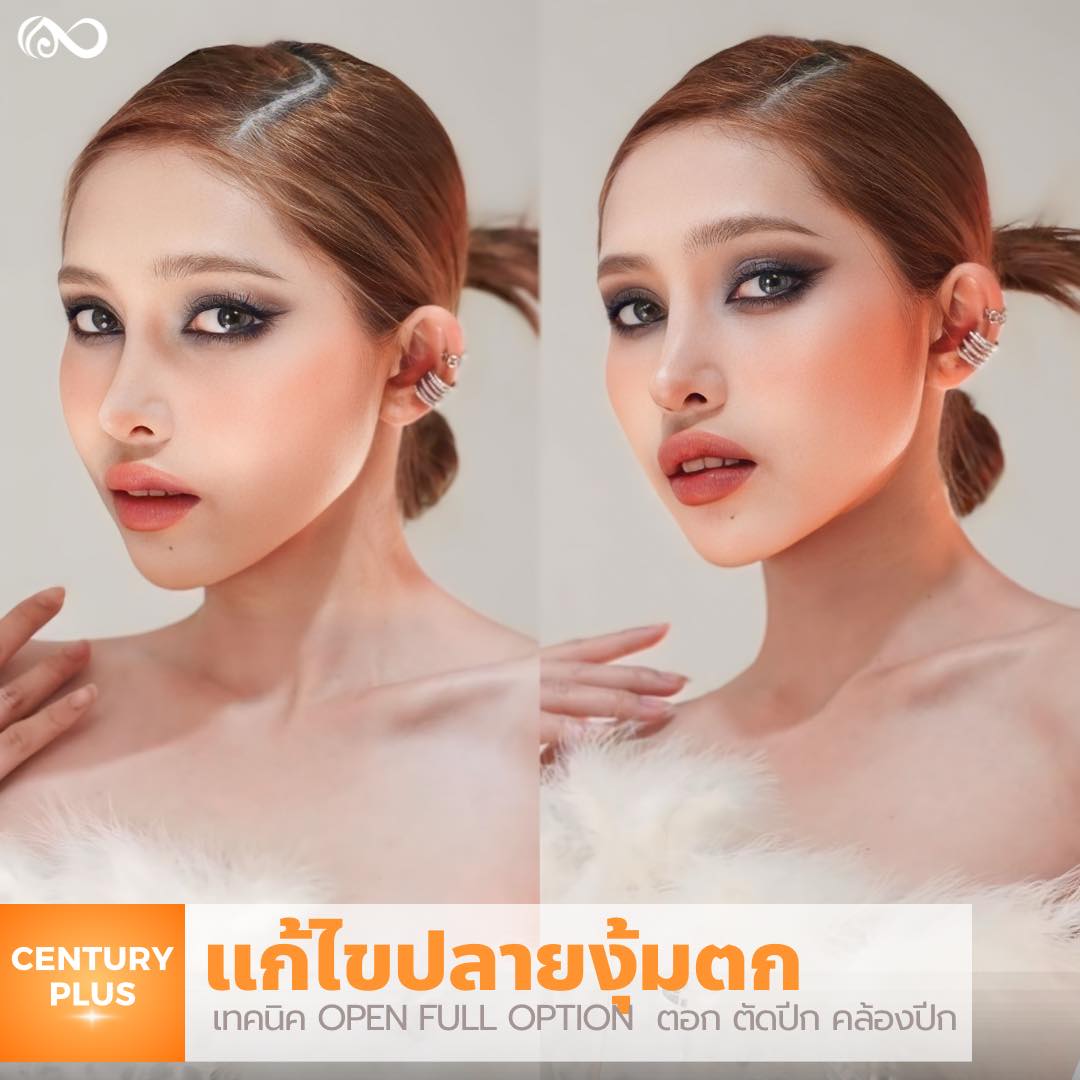 แก้จมูก #1102