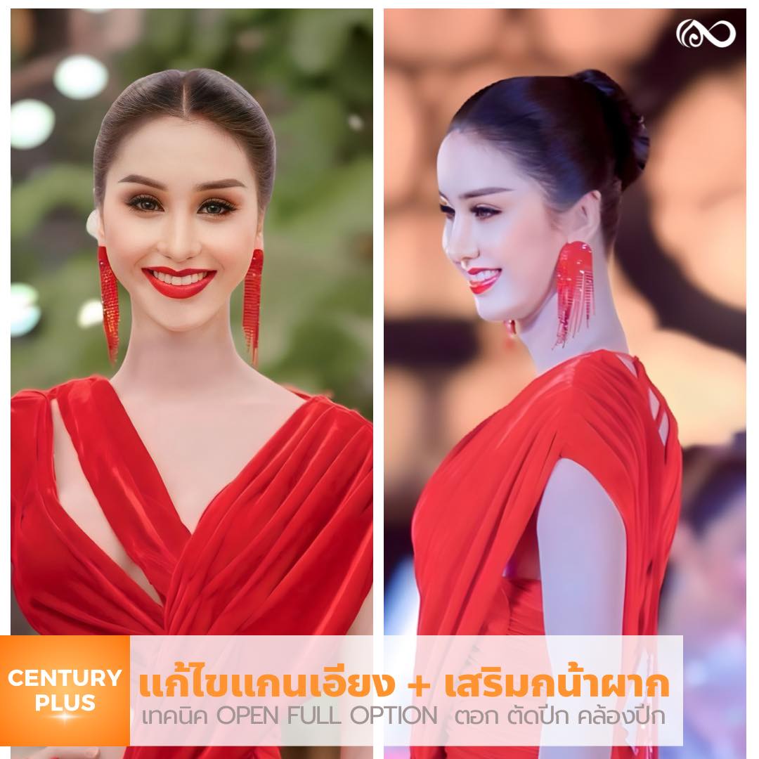 แก้จมูก #1106