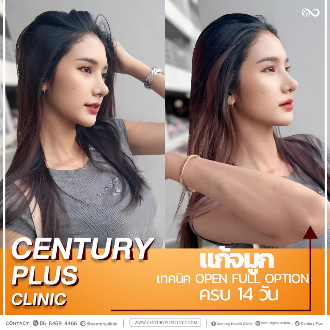 แก้จมูก #1123