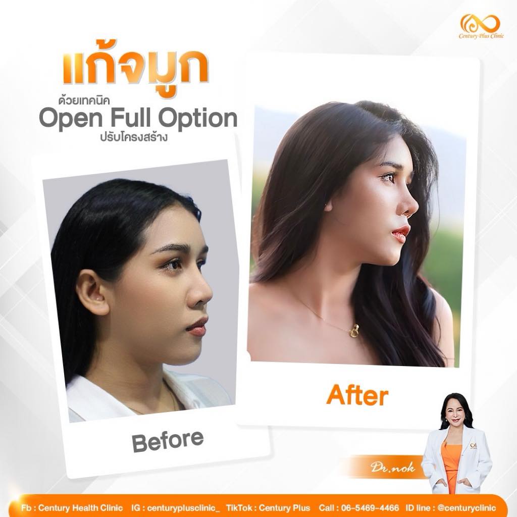 แก้จมูก #1124