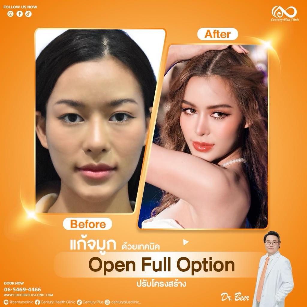 รีวิว แก้จมูก #1125 , Century Clinic Thailand แก้จมูก #1125
