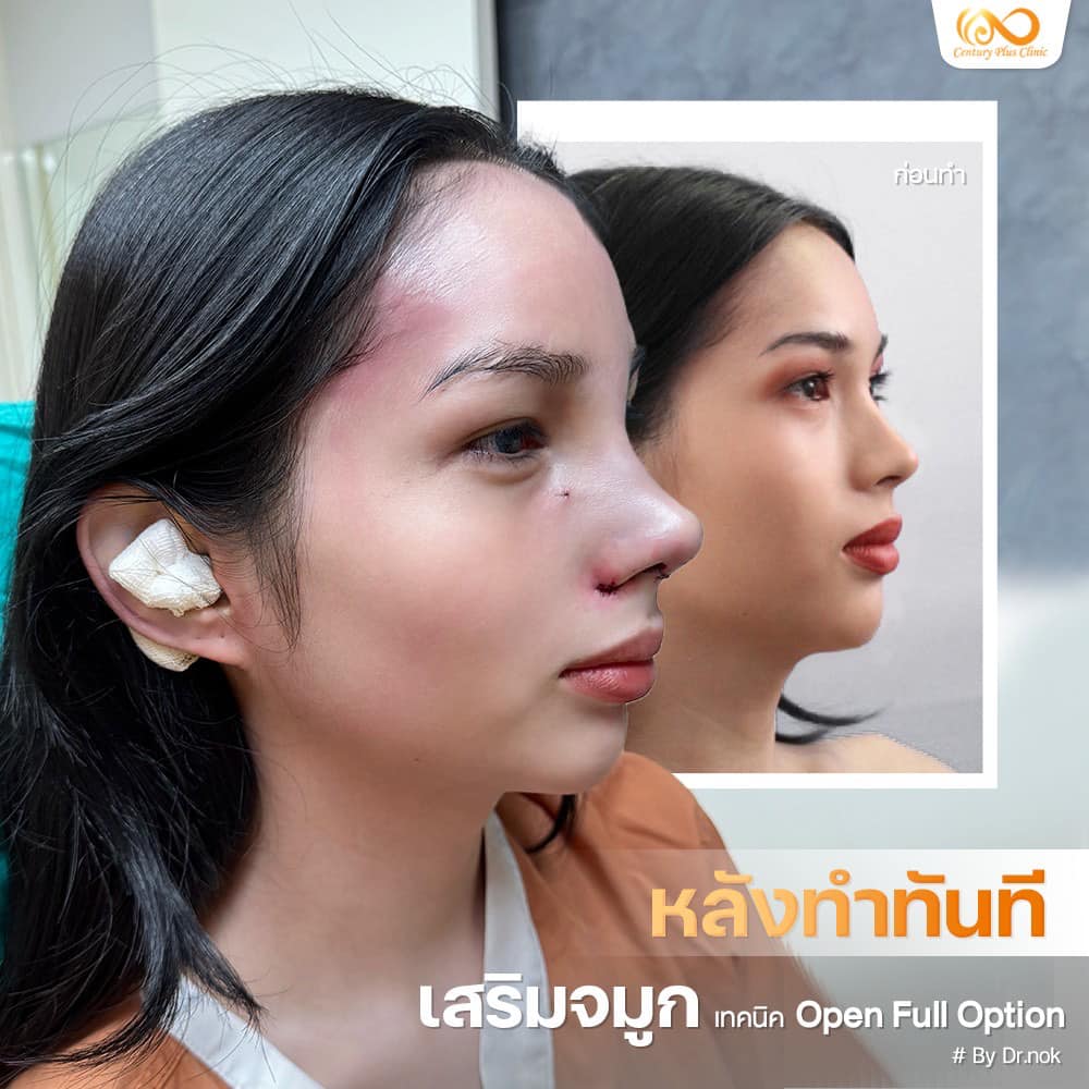 เสริมจมูก #1175