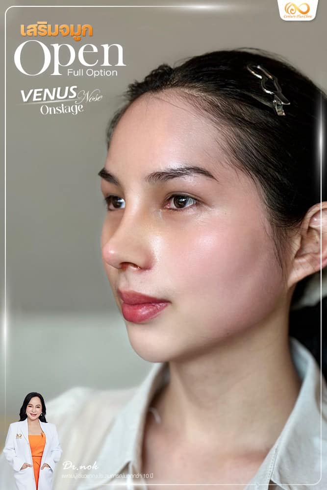 รีวิว เสริมจมูก #1191 , Century Clinic Thailand เสริมจมูก #1191