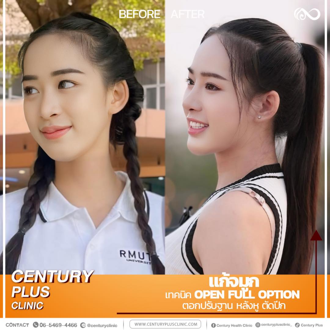 รีวิว แก้จมูก #1190 , Century Clinic Thailand แก้จมูก #1190