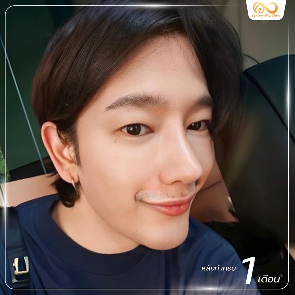 แก้จมูก 2#1168