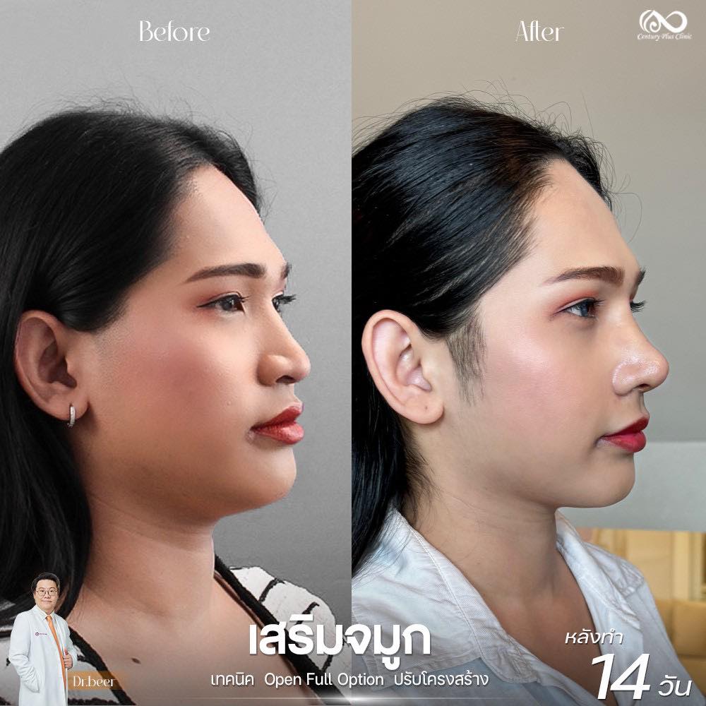 รีวิว เสริมจมูก #1198 , Century Clinic Thailand เสริมจมูก 1#1198