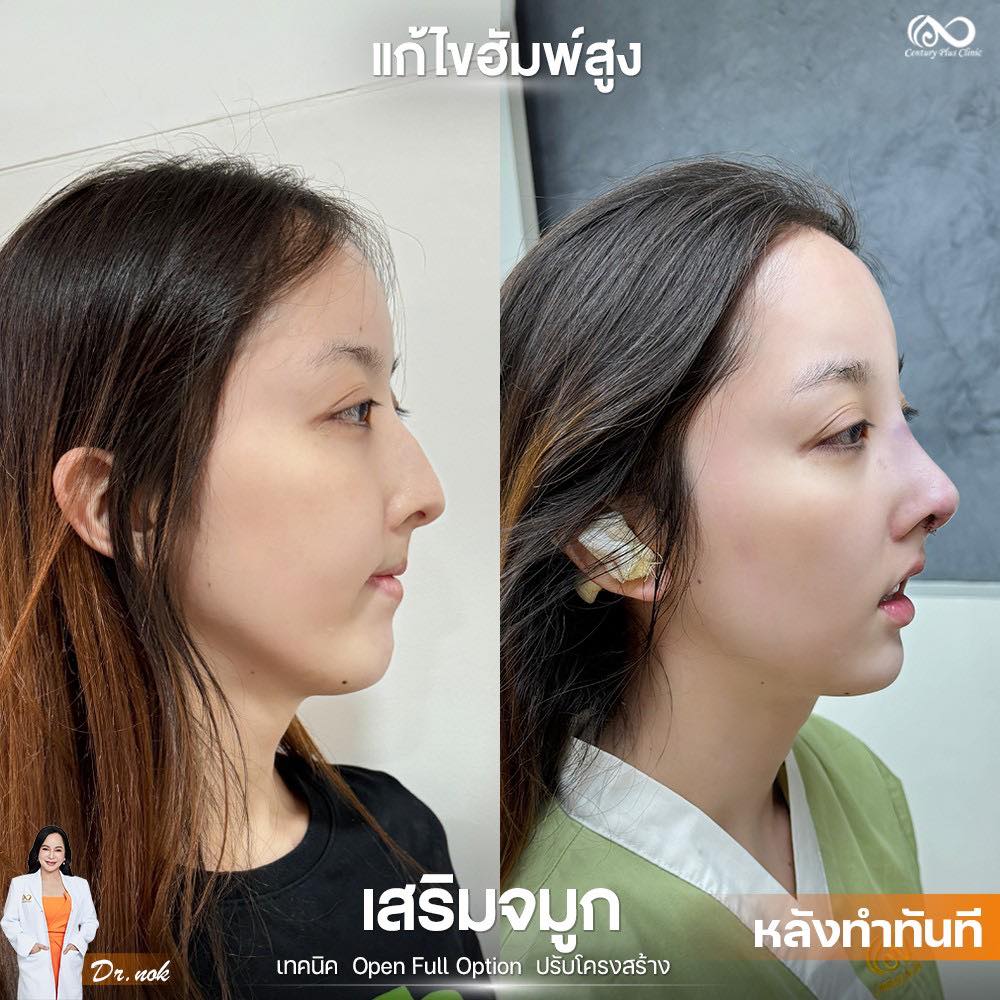 เสริมจมูก 1#1236
