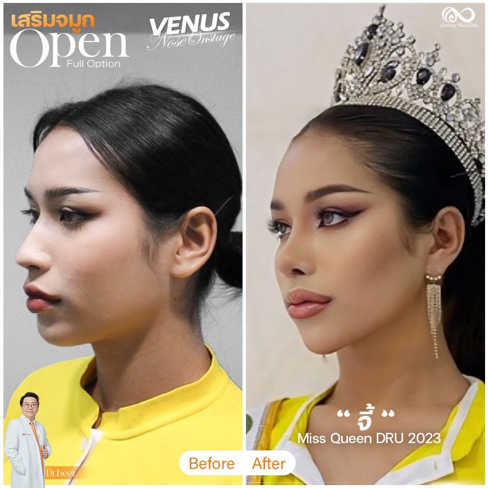 รีวิว เสริมจมูก #1199 , Century Clinic Thailand เสริมจมูก #1199