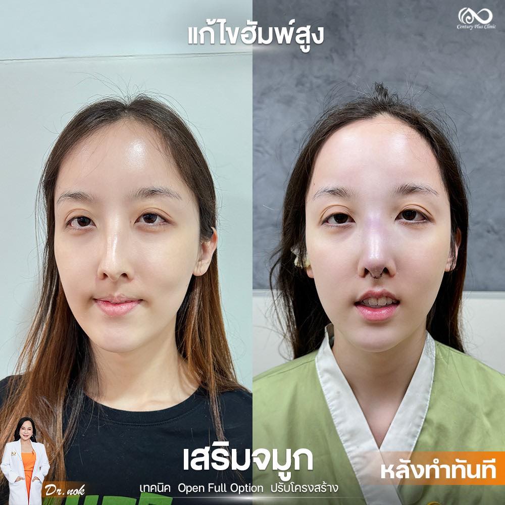 เสริมจมูก 2#1236